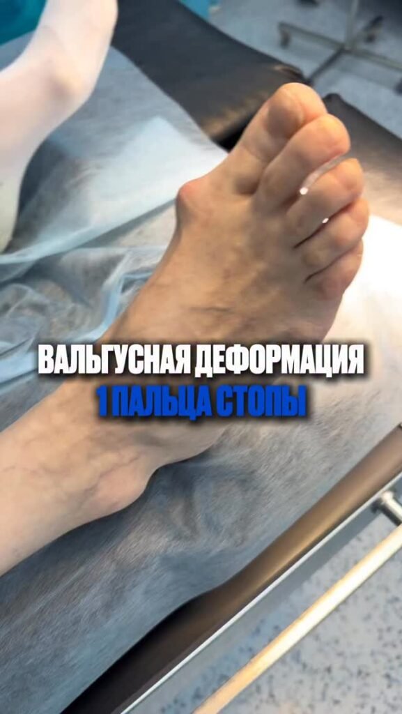 Вальгусная деформация большого пальца