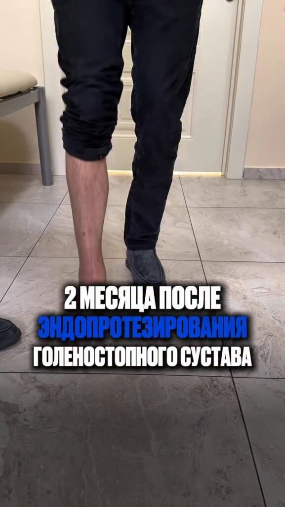 2 месяца после замены голеностопного сустава. История Сергея.