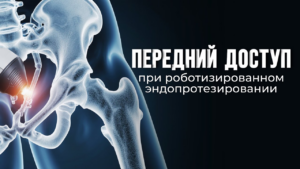 Передний доступ и робот Mako: как технологии делают замену сустава безопаснее и точнее